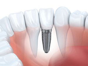 Dental-Implant