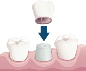 Single Dental Crown