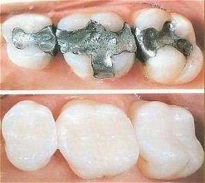 tooth-colored-fillings