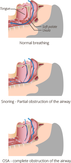 Sleep Apnea Infographic