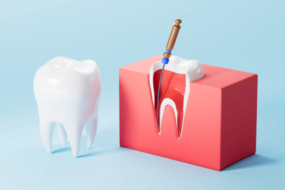 5 Misconceptions about Root Canal Therapy 